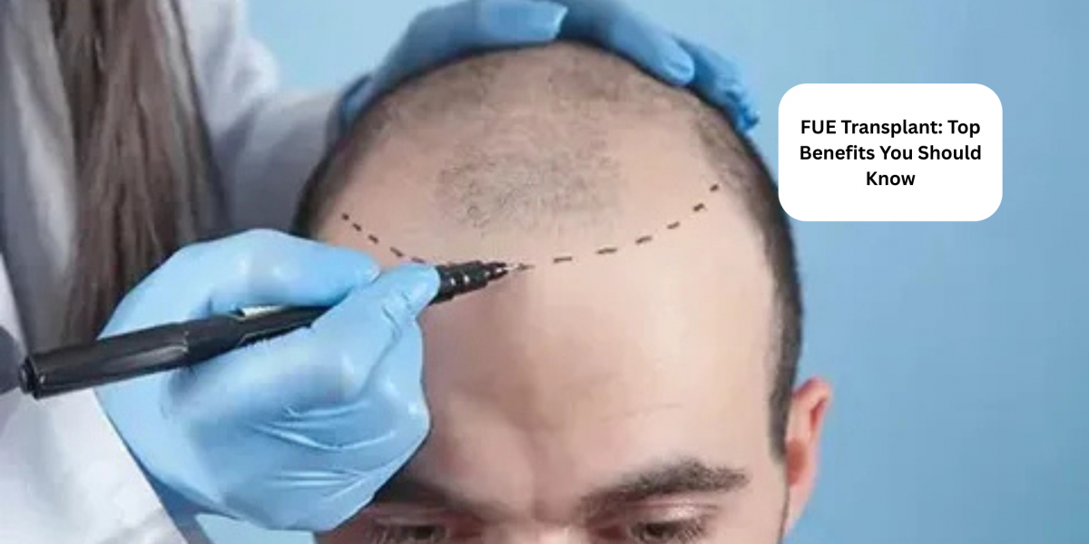FUE Transplant: Top Benefits You Should Know